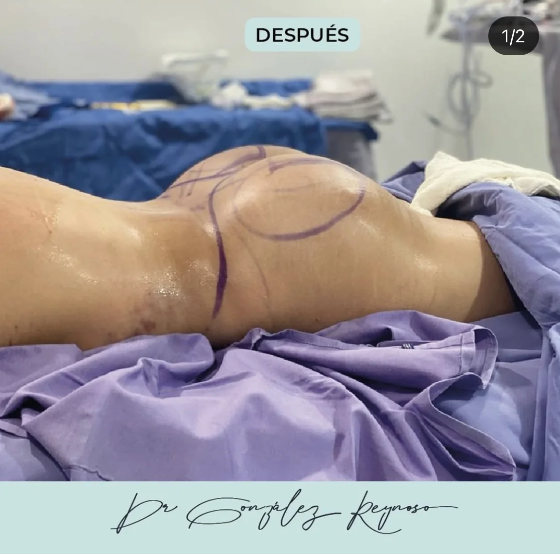 Resultado de lipoescultura